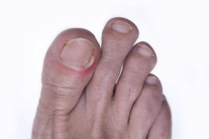 hard-dry-skin-on-side-of-big-toe-ppgbbe-intranet-biologia-ufrj-br